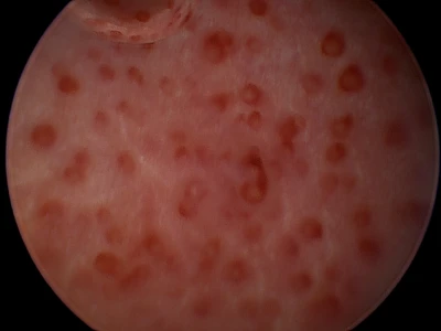 Blaas urachuslitteken Lampe Eva 348 UrethrovaginoCystoscopie 2024 02 09 095816 Brocks Bouvien Still 001